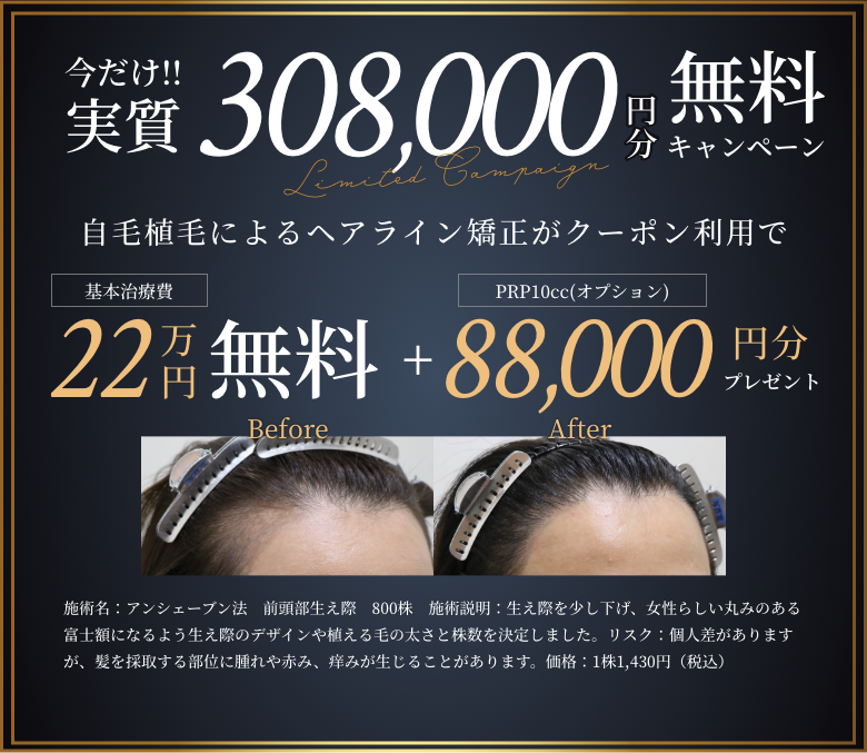 10周年キャンペーン 自毛植毛によるヘアライン矯正がクーポン利用で50万円（税込）