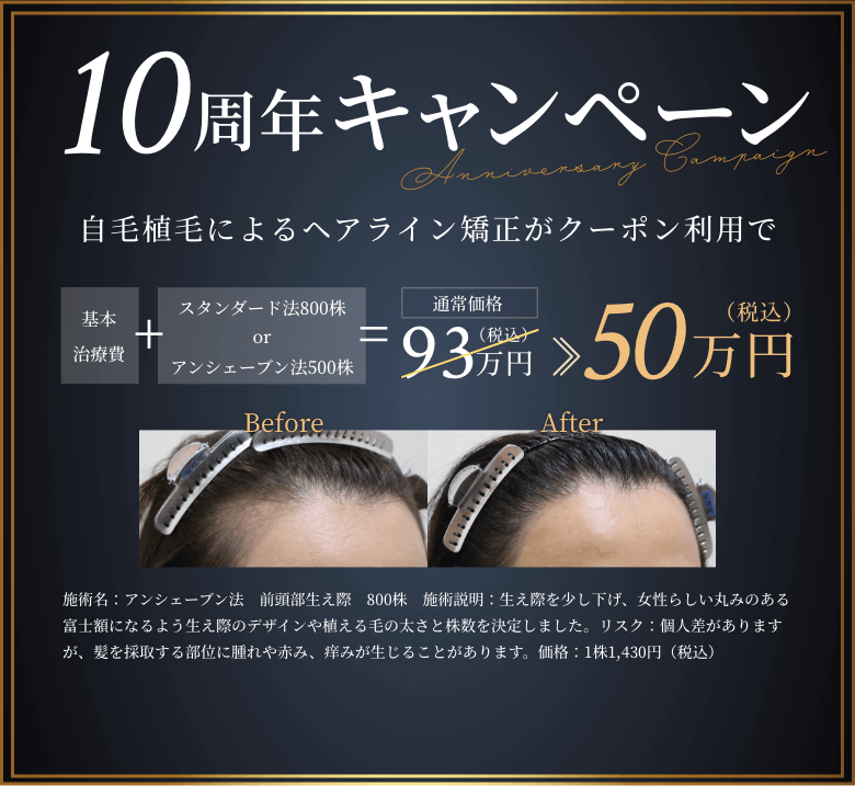 10周年キャンペーン 自毛植毛によるヘアライン矯正がクーポン利用で50万円（税込）