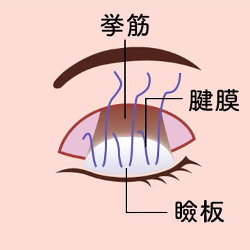 ③眼瞼挙筋腱膜の調整