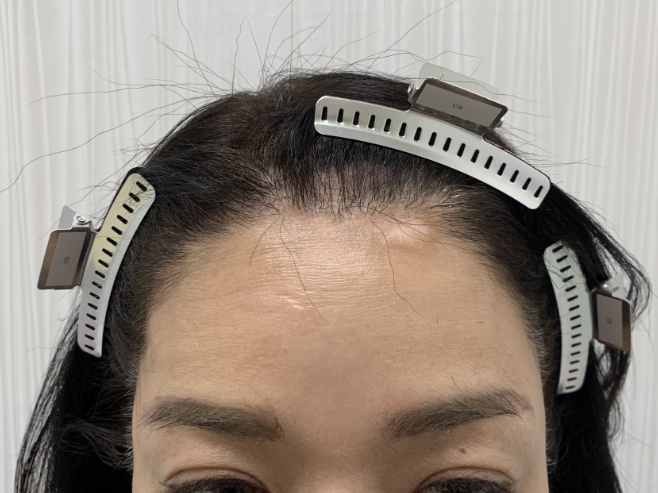 女性の薄毛治療