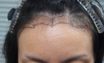 自然なヘアラインデザイン