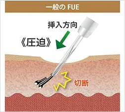 吸引で皮膚が安定、歪みにくい