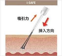 吸引力で毛根にかかる圧を減らす