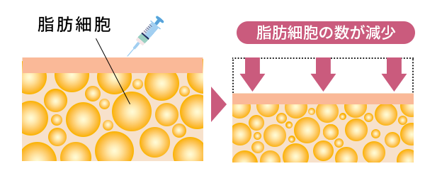 脂肪溶解注射