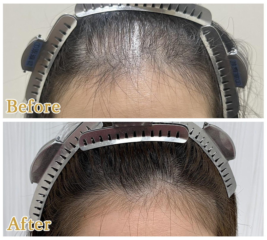 アンシェーブン法　生え際 　1,500株